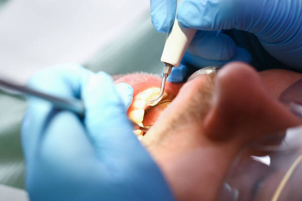 Best Emergency Dental Extractions in Barrington Hls, IL