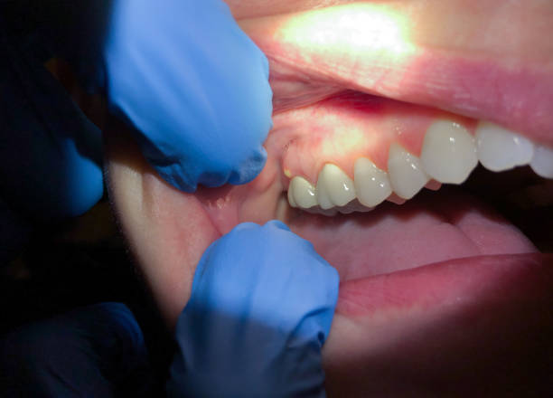 Best Emergency Dentist for Lost Fillings or Crowns in Barrington Hls, IL