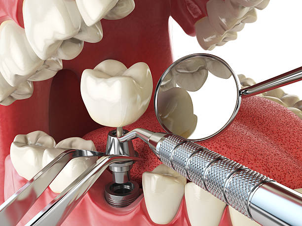 Best Emergency Root Canal Treatment in Barrington Hls, IL